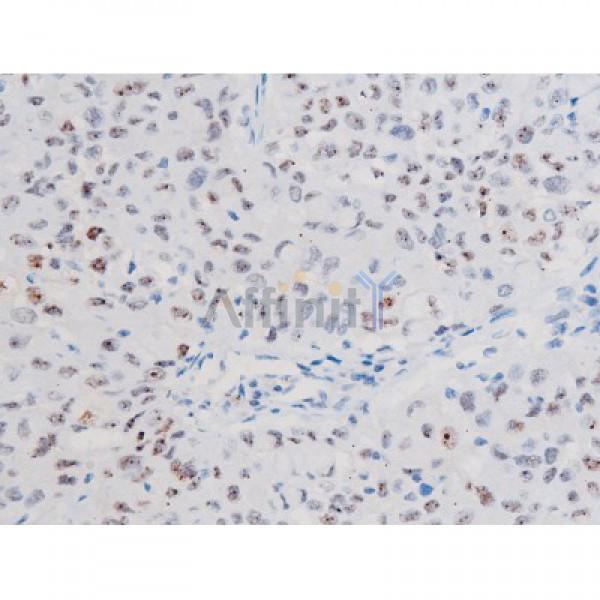 Phospho-STAT1 (Ser727) Antibody - AF3299 at 1/200 staining Human lung cancer tissue sections by IHC-P.